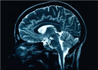 Studiu: Mutațiile cancerelor de sânge și legătura cu boala Alzheimer